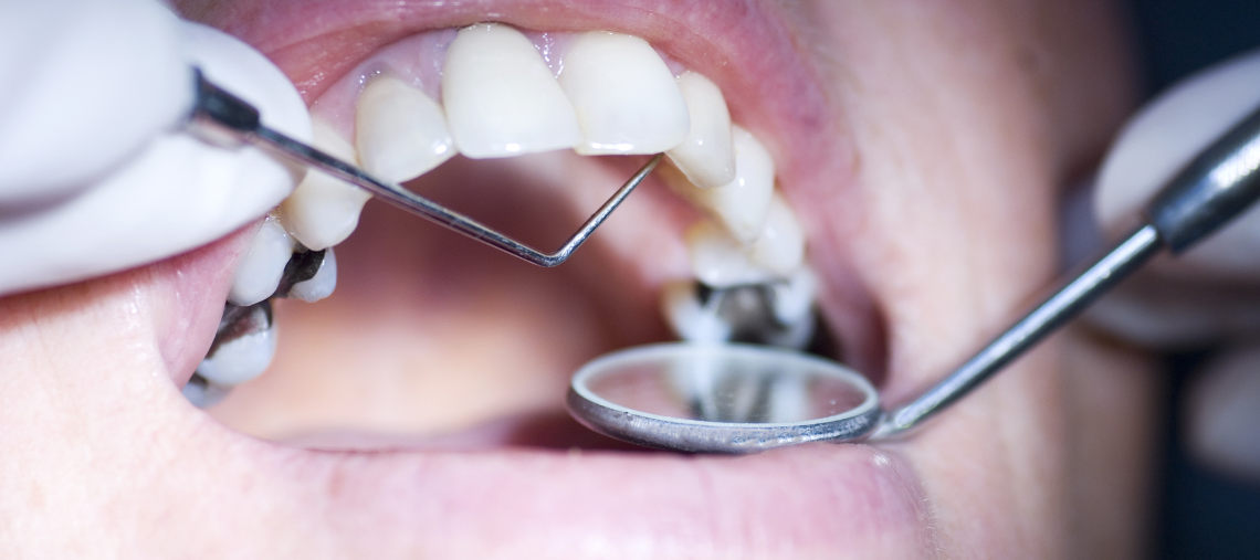 Silver Amalgam Fillings Toxicity Dr. Ron Richardson